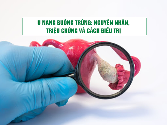 U nang buồng trứng: Nguyên nhân, triệu chứng và cách điều trị